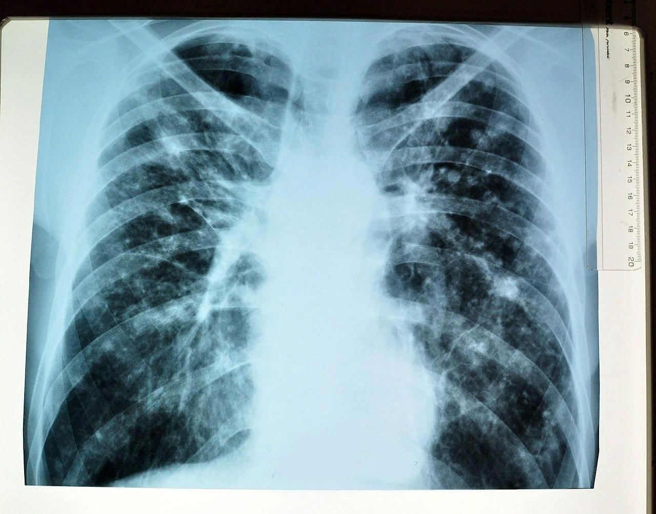 Открыиая форма туберкулёза