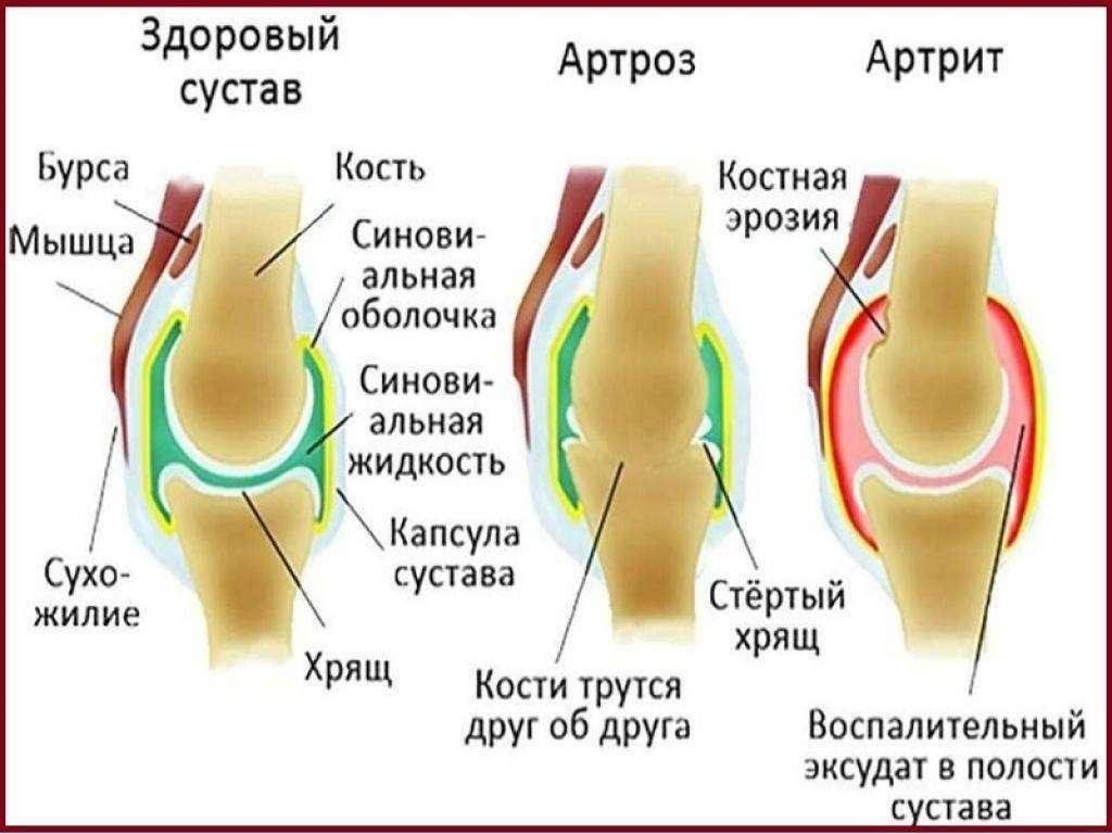 Артроз суставов симптомы и лечение фото Ревматизм и артроз" - беседа с участием фельдшера 2023, Апастовский район - дата